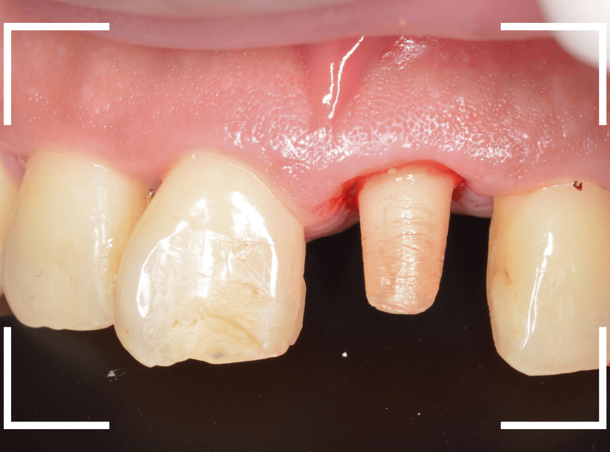 セラミック治療(前歯・クラウン)5-9