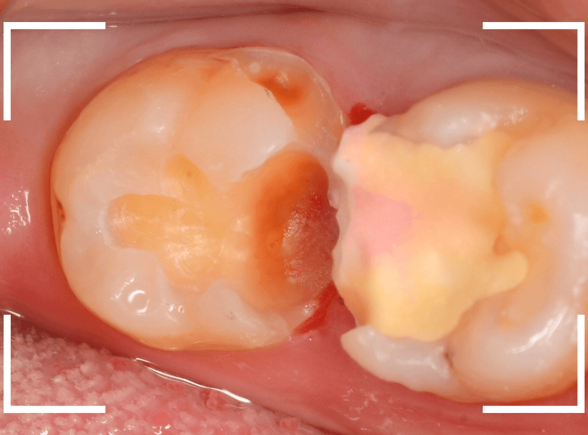 歯と歯の間の虫歯23-9