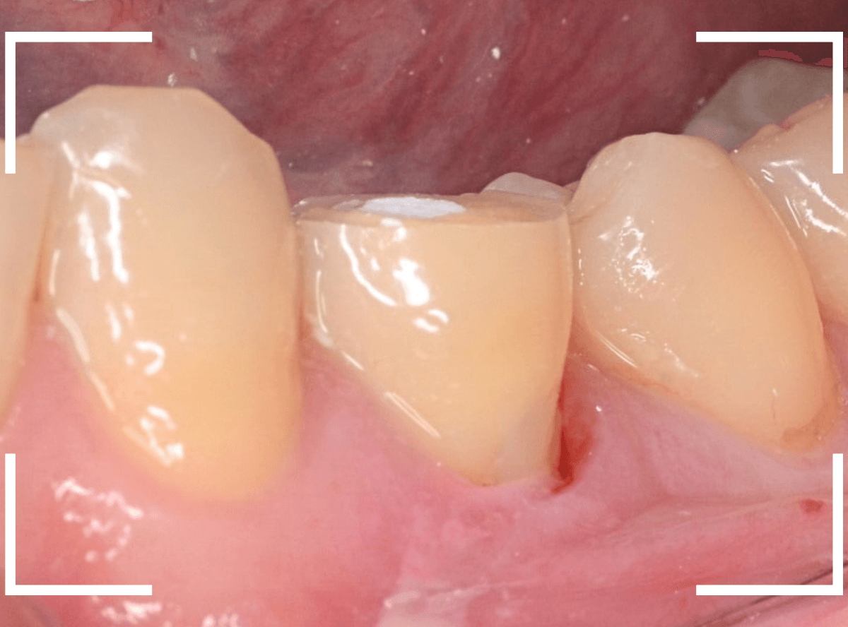 歯頚部う蝕の治療6