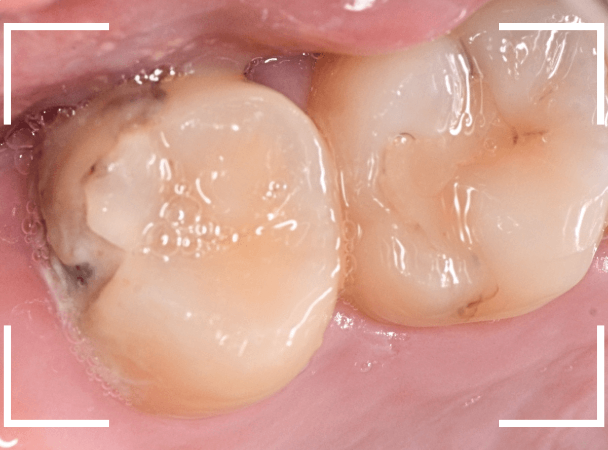 気づかないうちに深い虫歯3-2