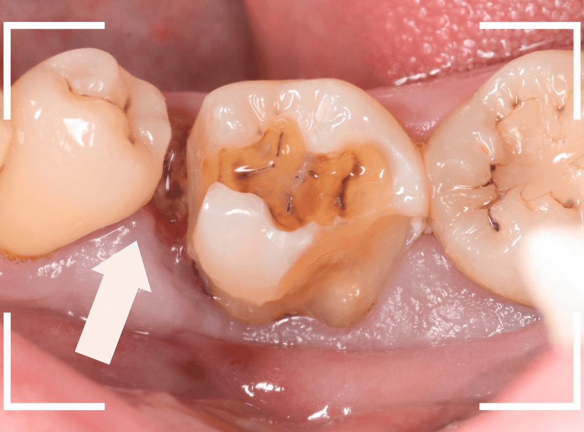 つめものの下の深い深い虫歯12-4