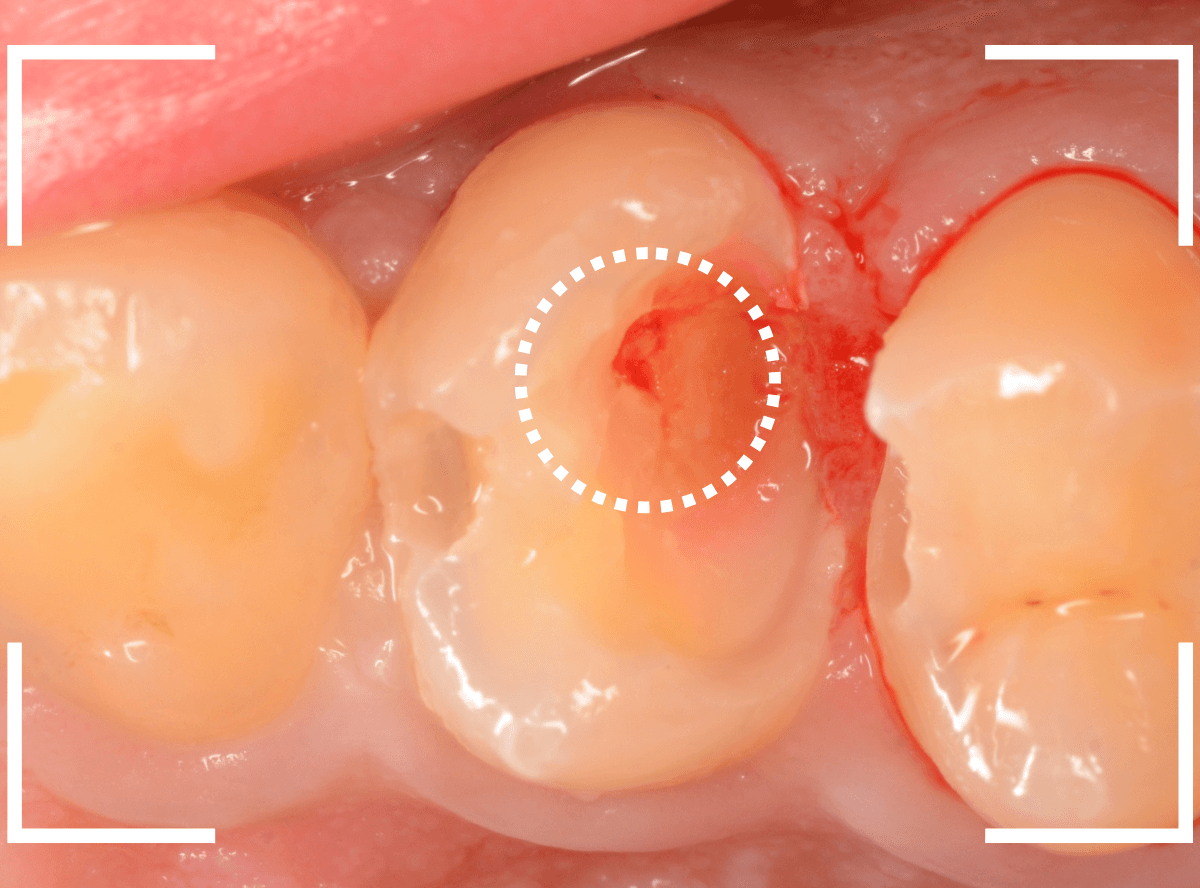歯と歯の間の虫歯19-5