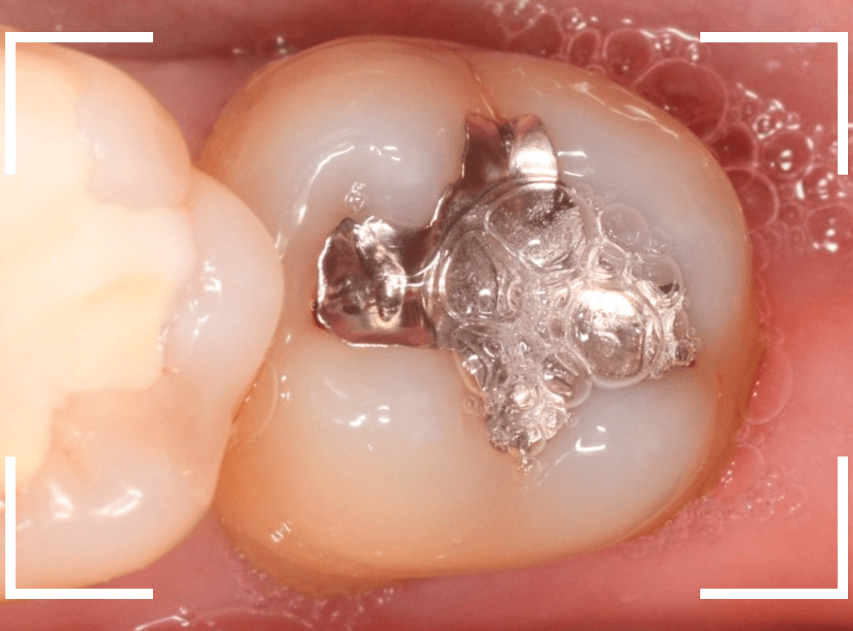 つめものの下の深い深い虫歯20-1