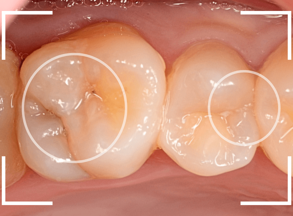 セラミック治療(インレー)32-1