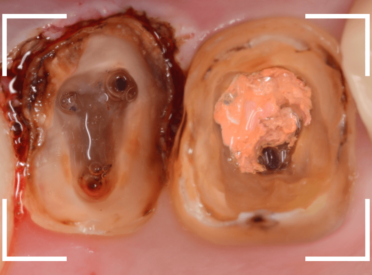 歯の土台の再治療3-9