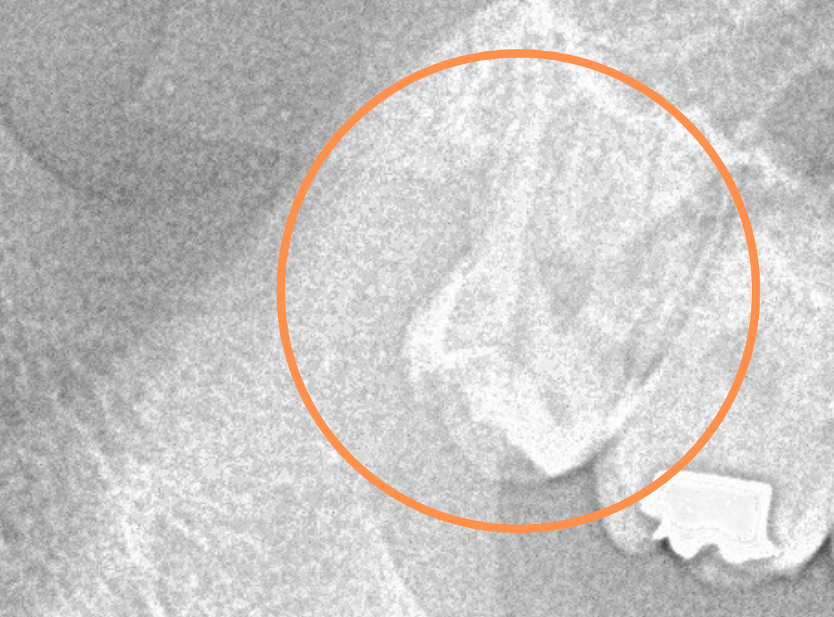 おやしらずの抜歯7-1