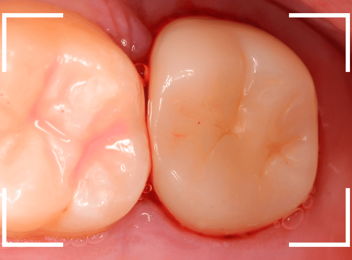 セラミック治療(クラウン・奥歯)10-7