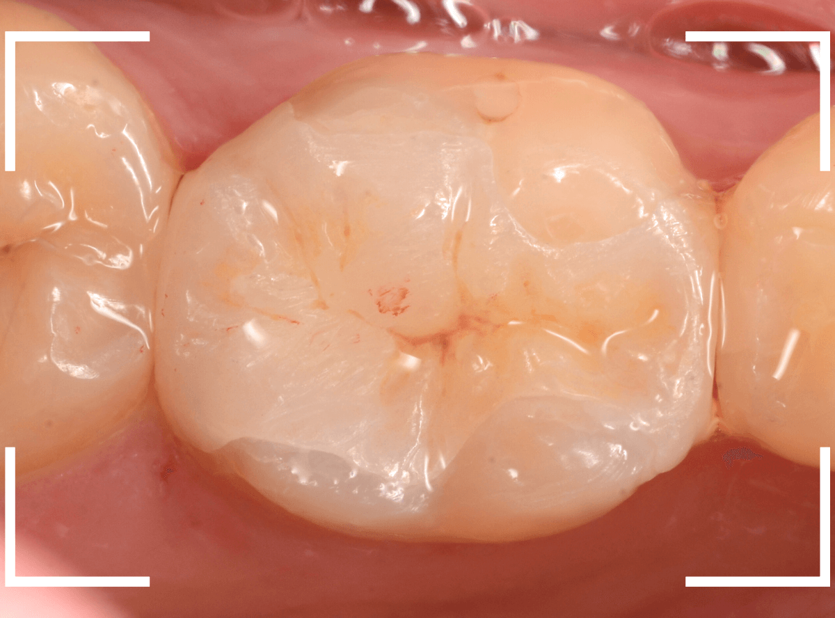 セラミック治療(インレー)29-4
