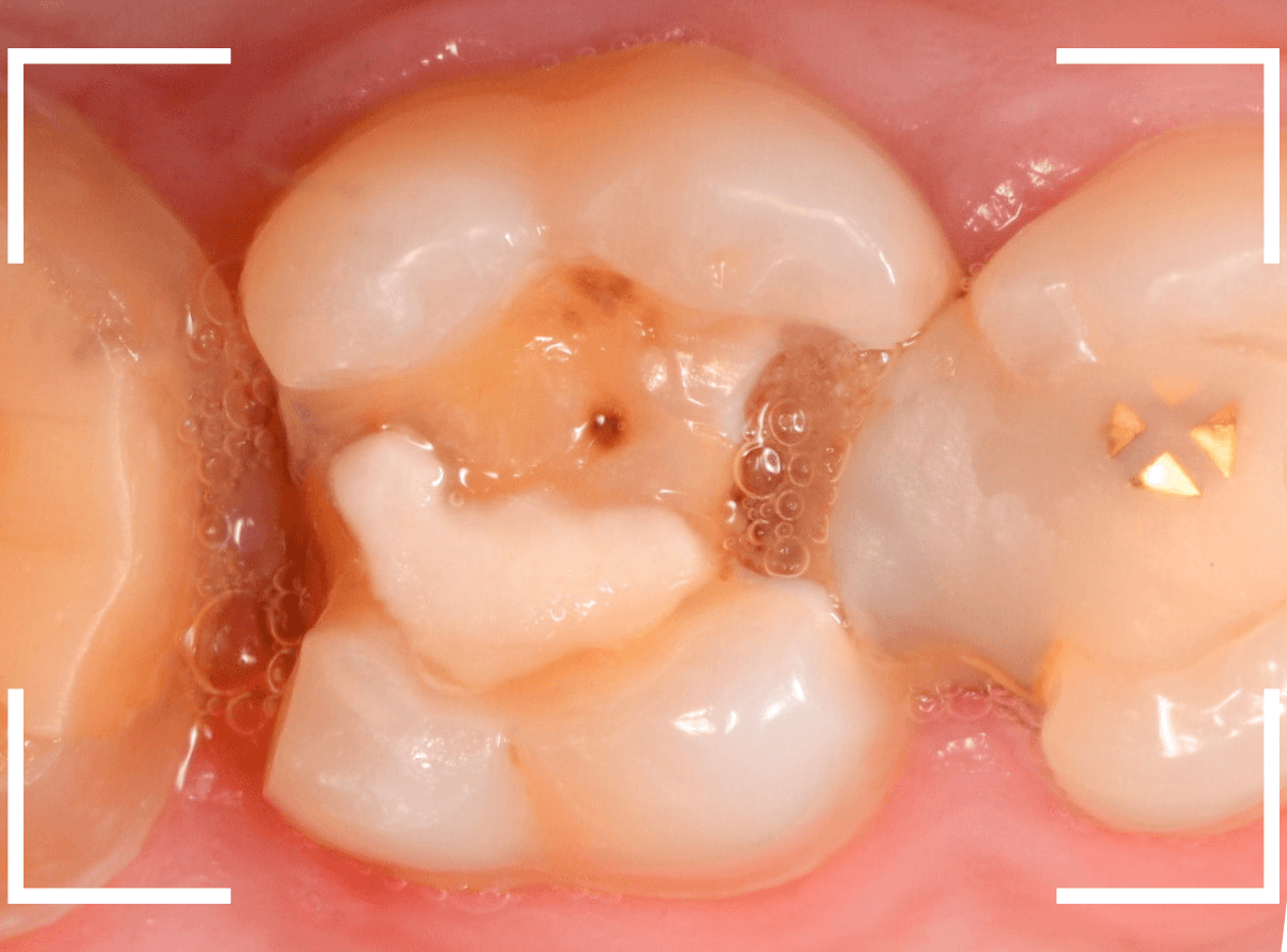 気づかないうちに深い虫歯7-1