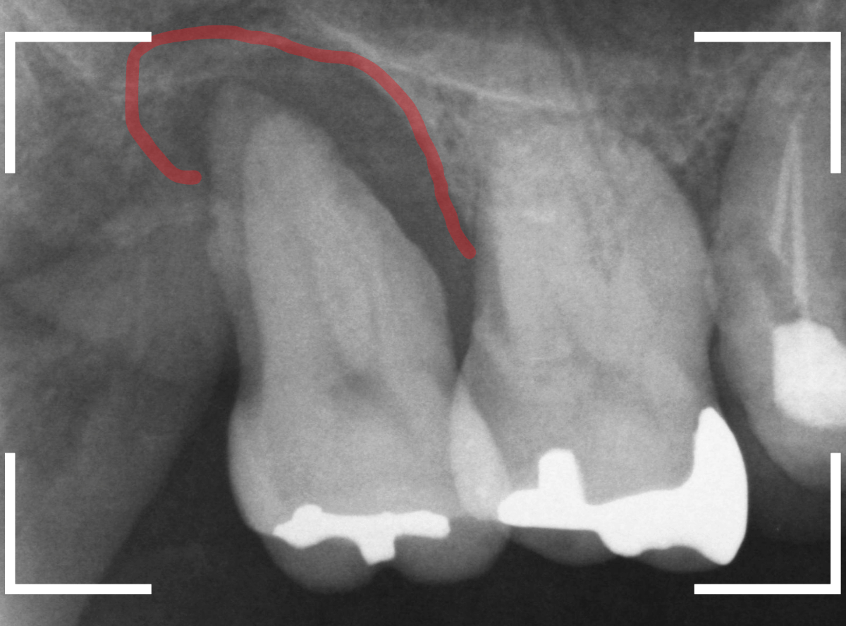歯周病が原因で、抜歯2-2