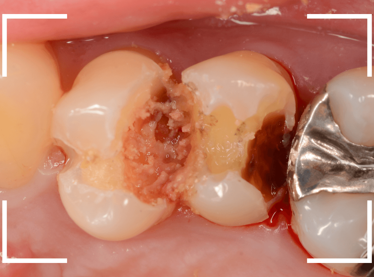歯と歯の間の虫歯21-1