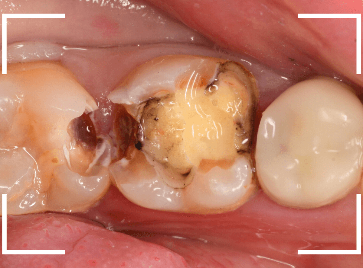 歯と歯の間の虫歯18-3