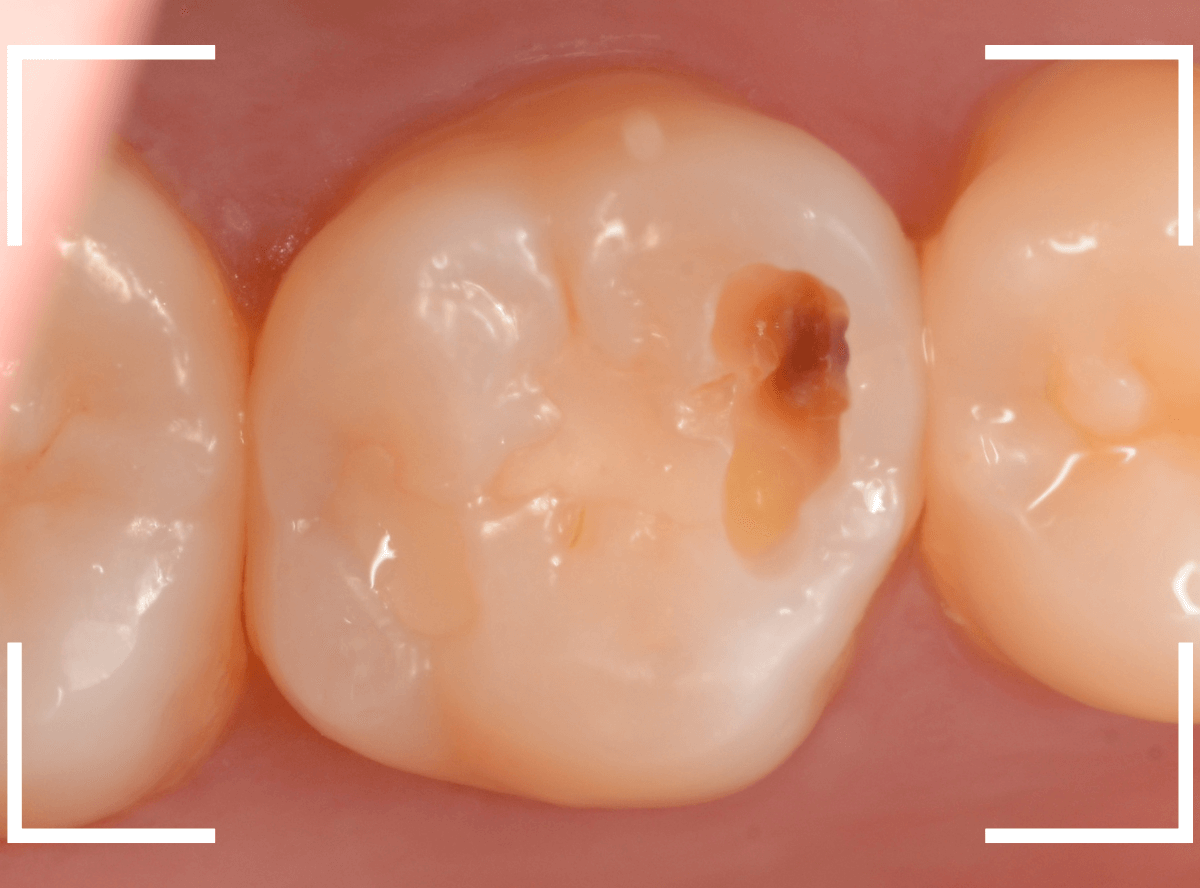 歯と歯の間の虫歯24-3