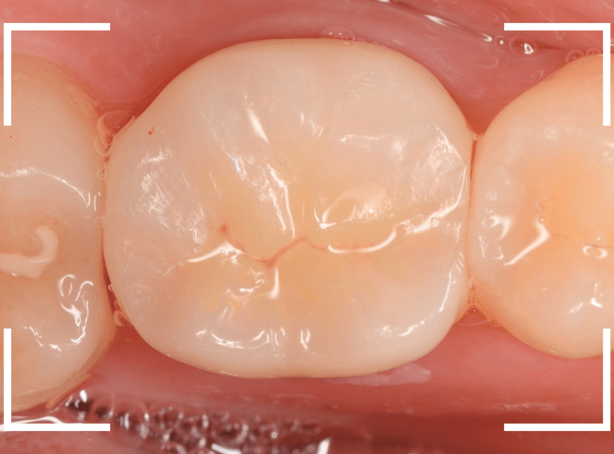 セラミック治療(クラウン・奥歯)15-4