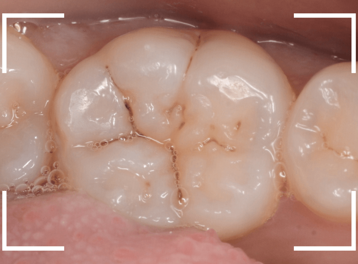 レントゲンでわかりづらい虫歯4-1