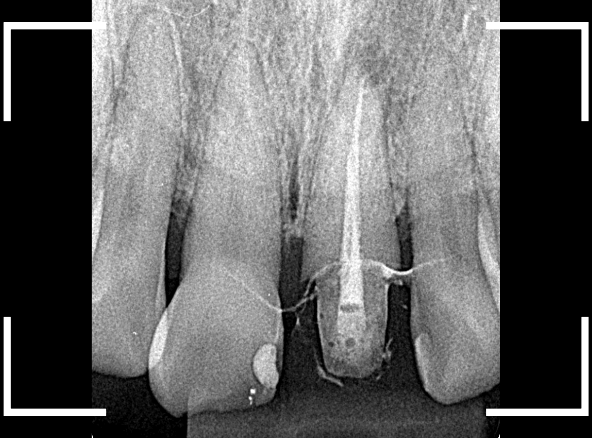 セラミック治療(前歯・クラウン)5-4