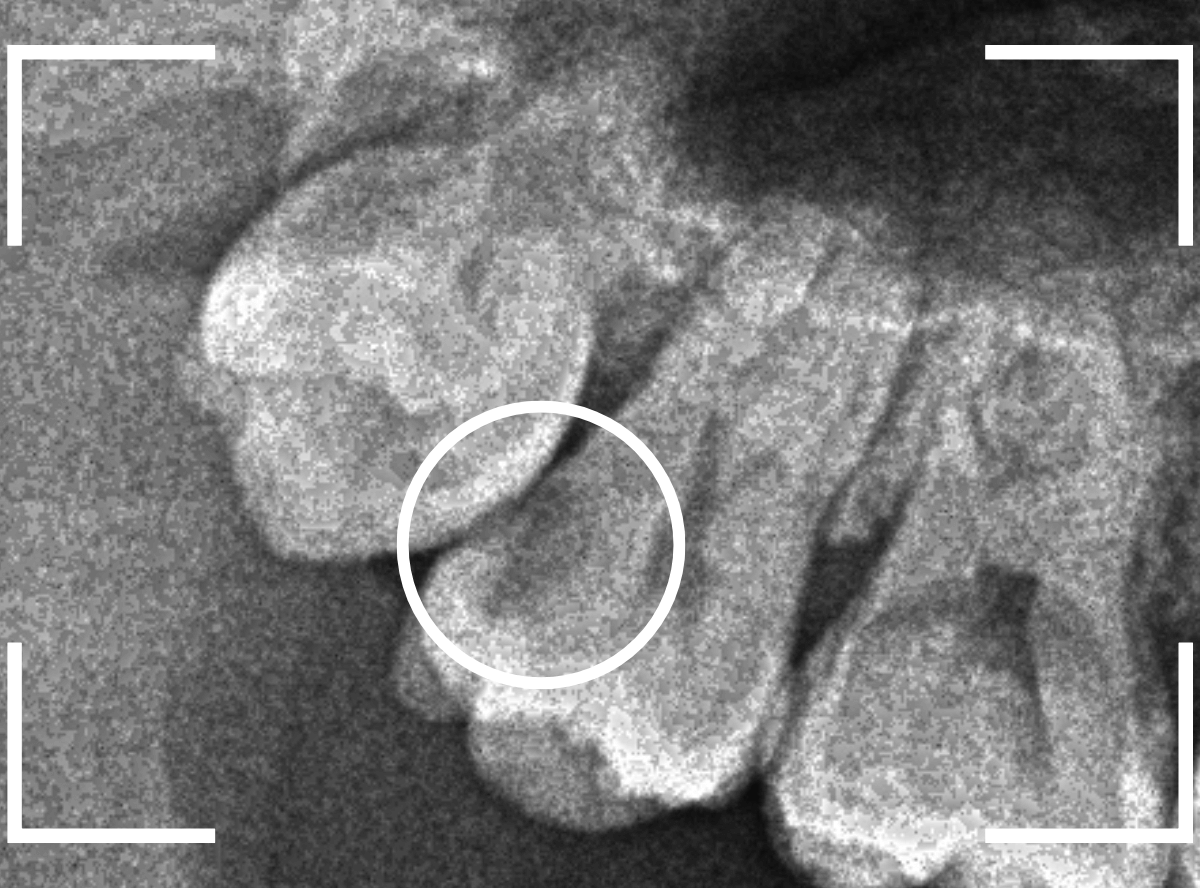 おやしらずの抜歯11-1