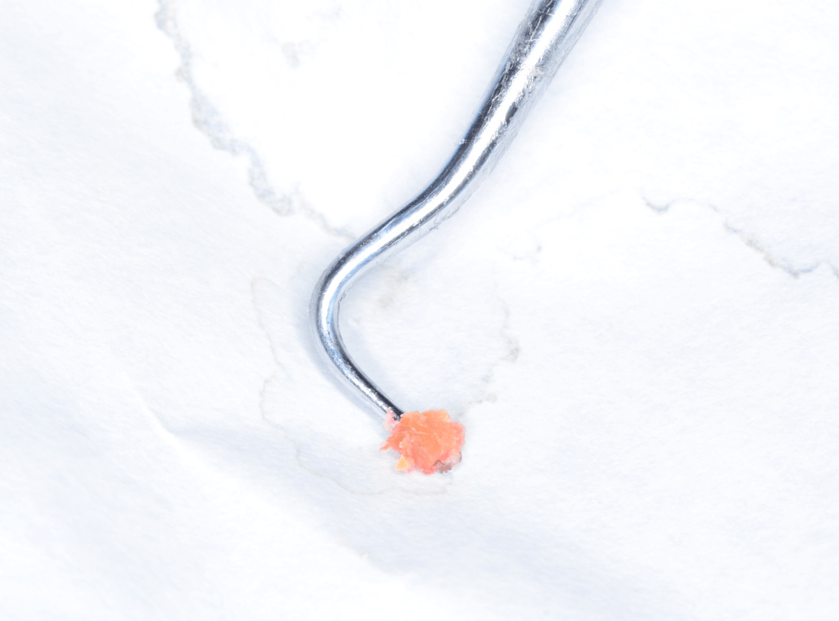 つめものの下の深い虫歯(画像)6-5