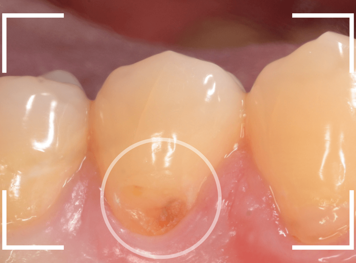 知覚過敏の画像3-1