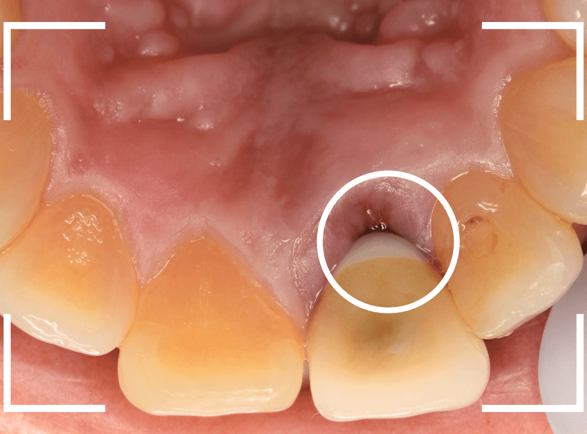 セラミック治療(前歯・クラウン)3-10