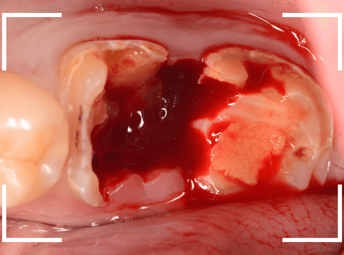 気づかないうちに深い虫歯15-4