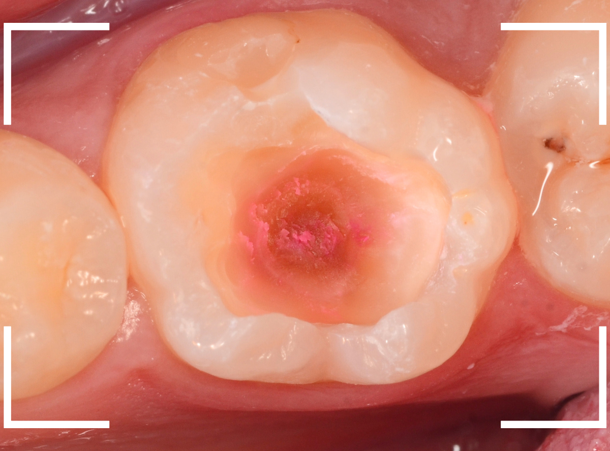 小窩裂溝う蝕5-5