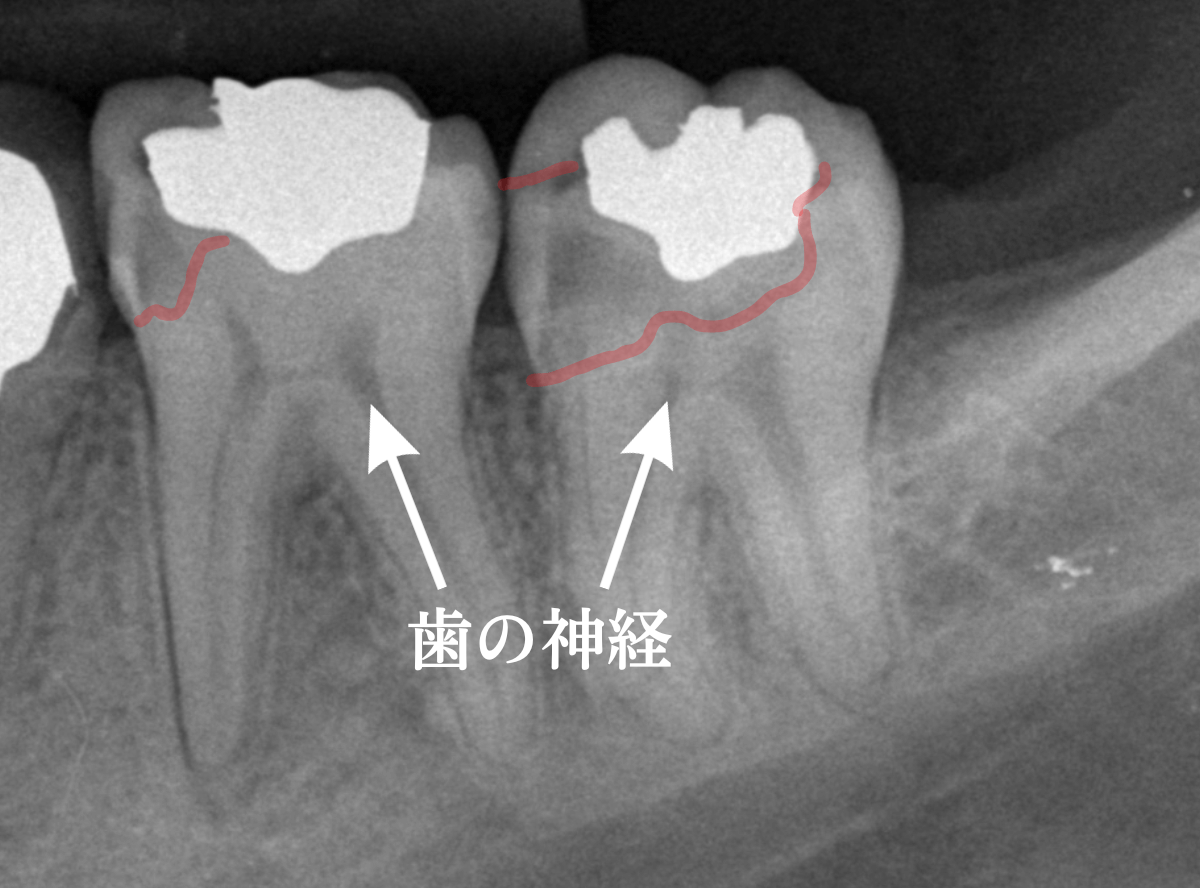 つめものの下の深い虫歯(画像)1-2
