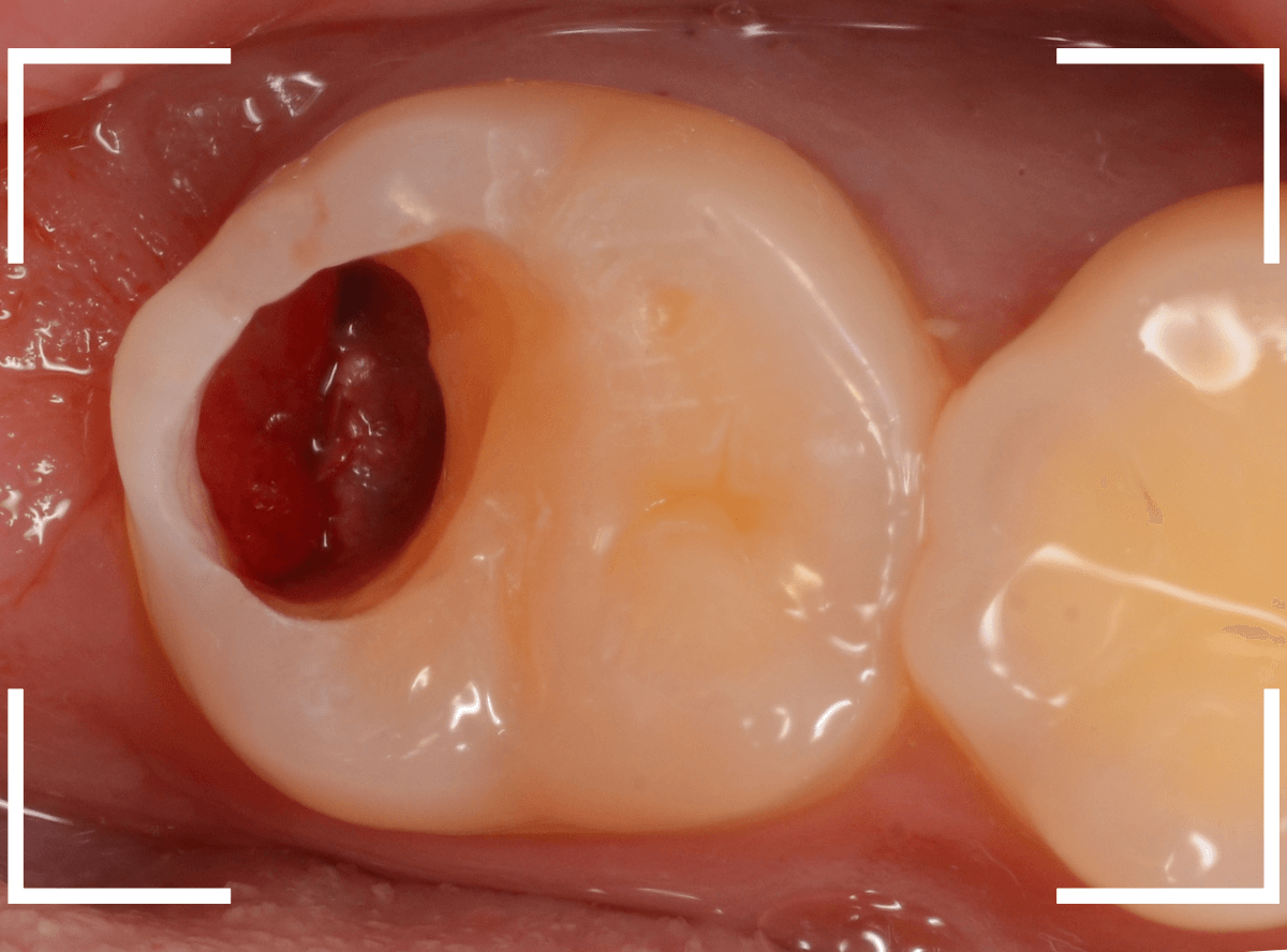 気づかないうちに深い虫歯12-5