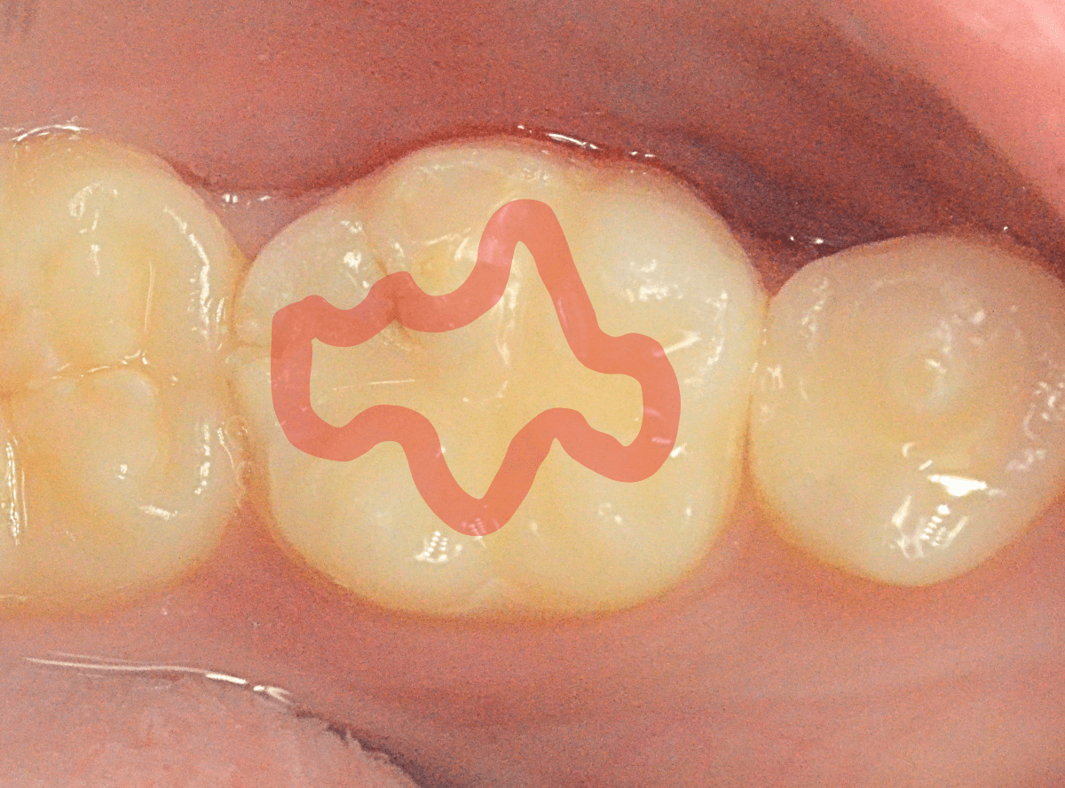 セラミック治療(インレー)7-1