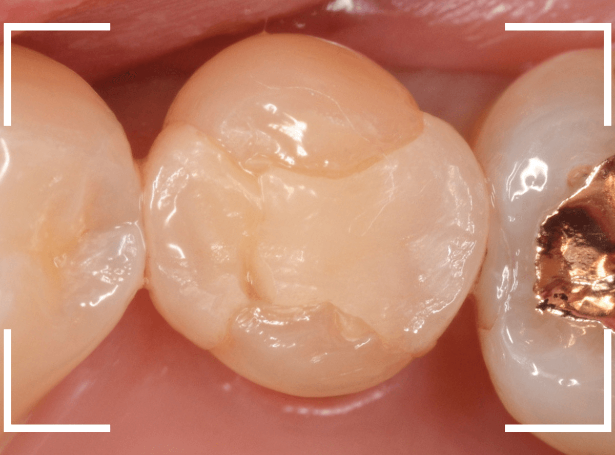 セラミック治療(インレー)25-1