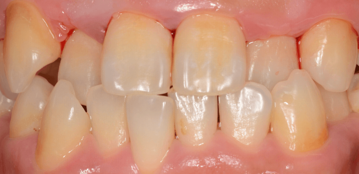 歯肉の中の歯石（歯肉縁下歯石）除去(画像）4-5