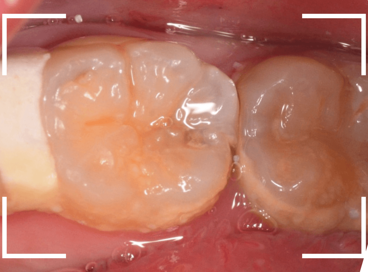 歯と歯の間の虫歯12-5