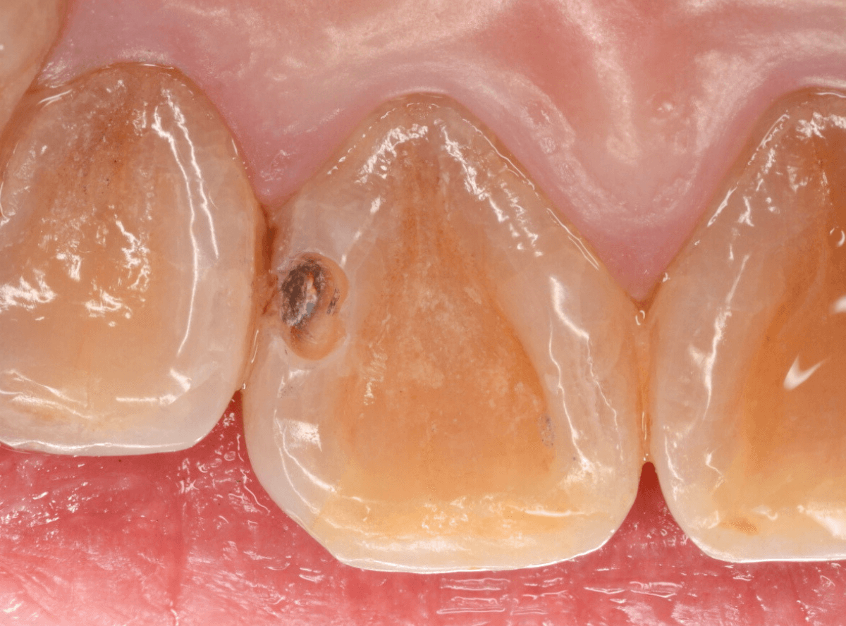 コンポジットレジン治療5-2