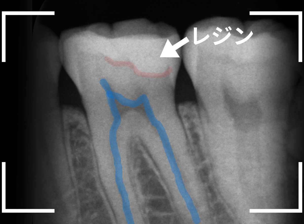 レントゲンでわかりづらい虫歯18-2