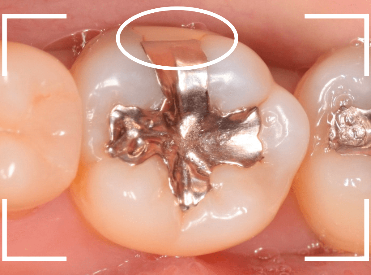 つめものの下の深い深い虫歯20-1