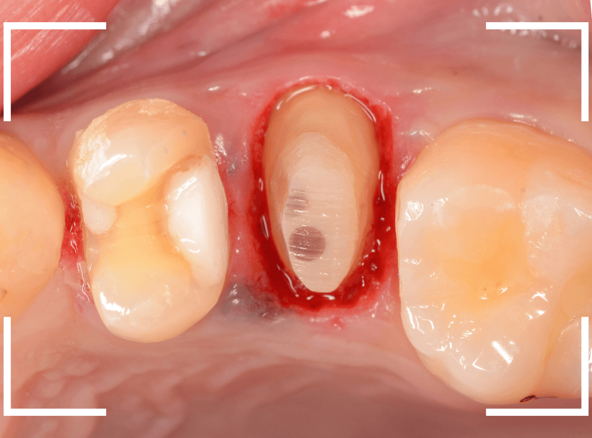 セラミック治療(クラウン・奥歯)9-7