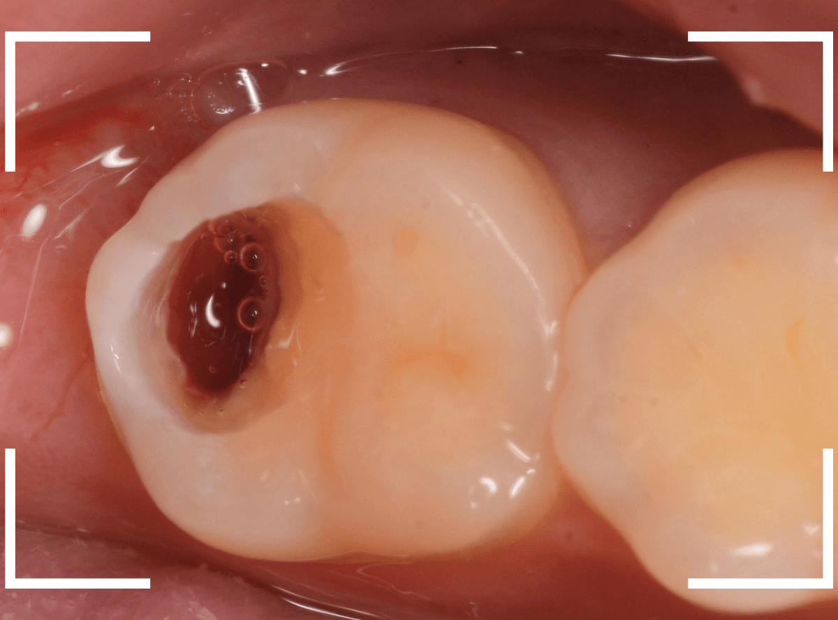 気づかないうちに深い虫歯12-4