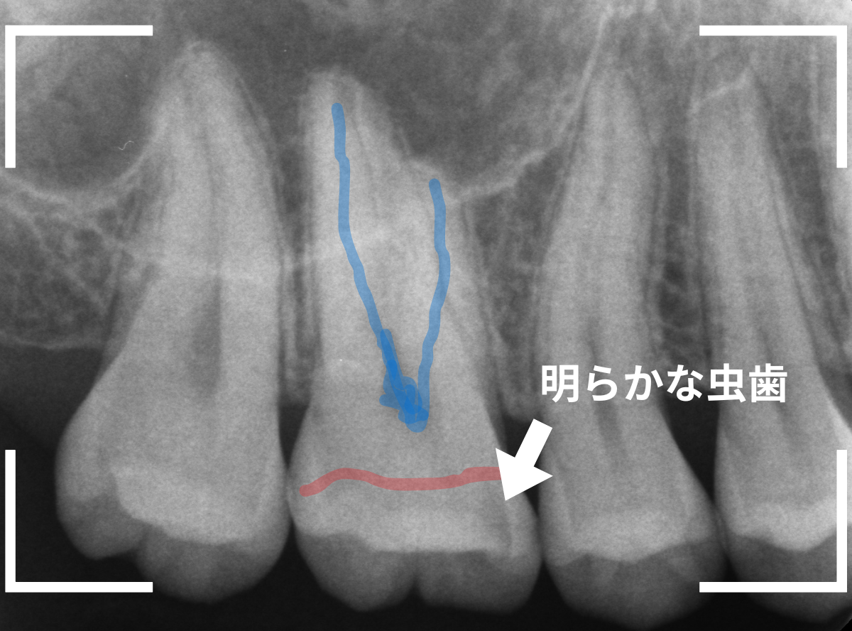 歯と歯の間の虫歯24-2