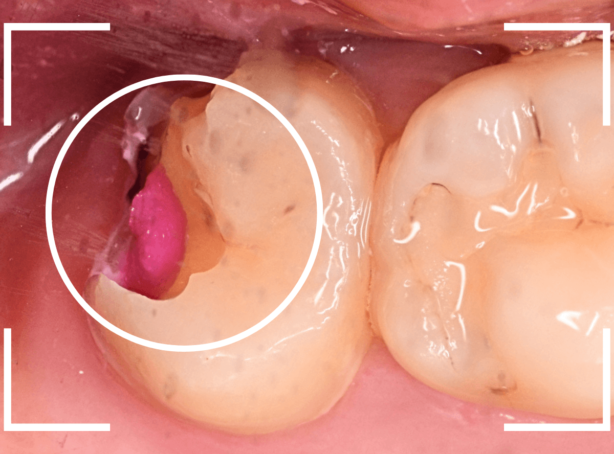 気づかないうちに深い虫歯3-4