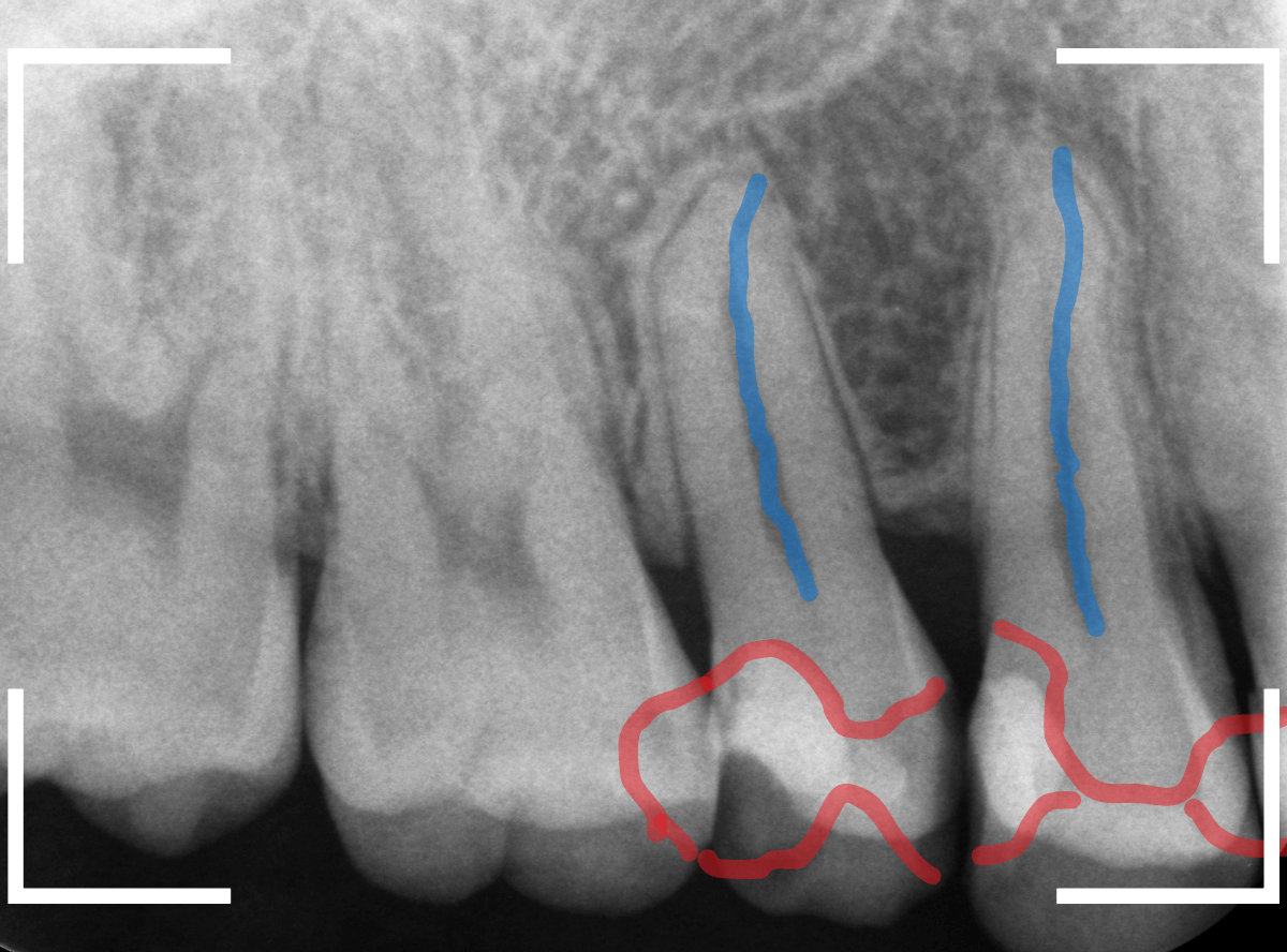 気づかないうちに深い虫歯8-2