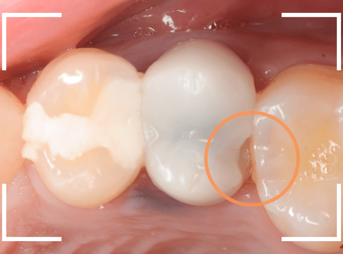 セラミック治療(クラウン・奥歯)9-1