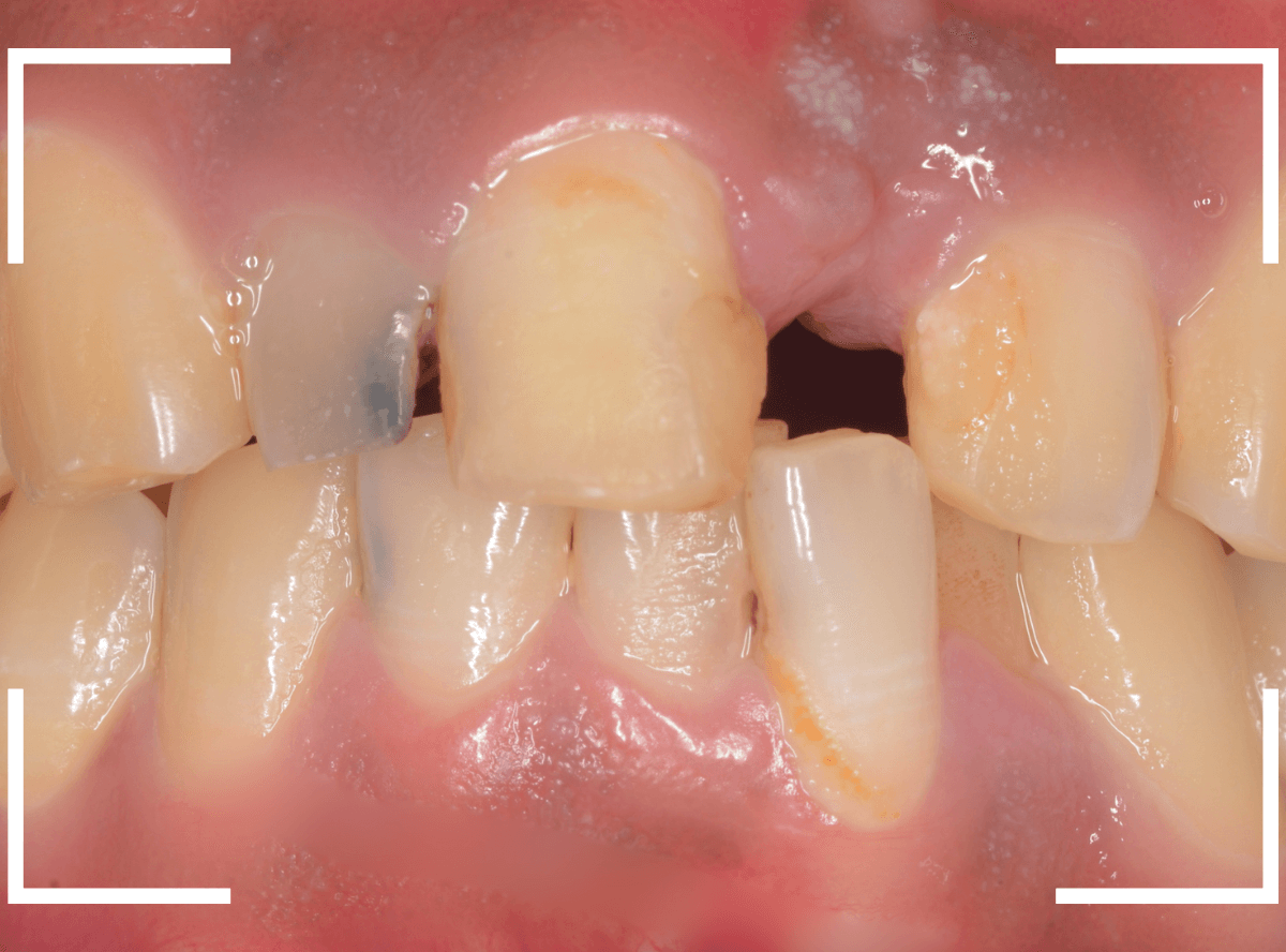 セラミック治療(前歯・クラウン)4-1