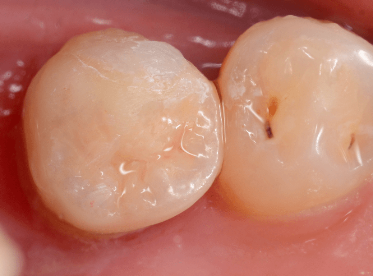 セラミック治療(インレー)14-3