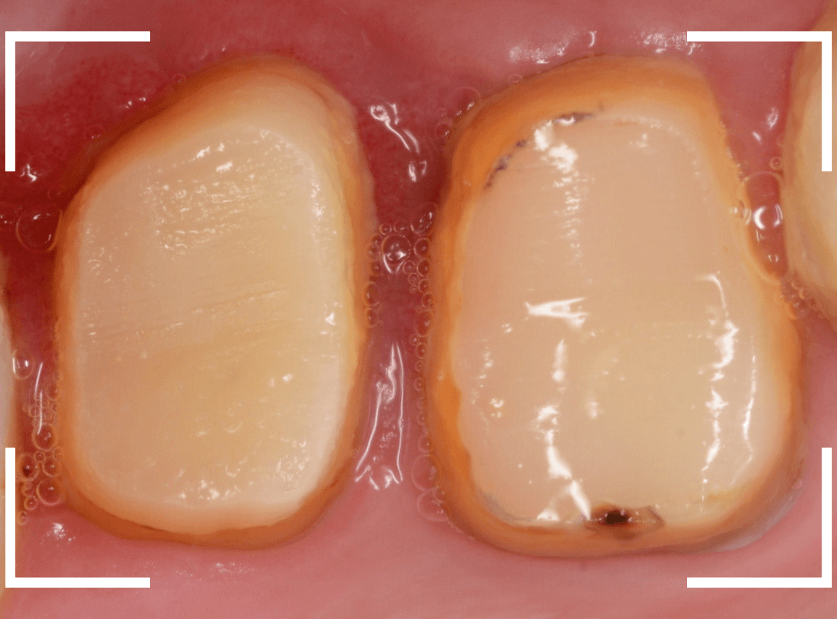 歯の土台の再治療3-10