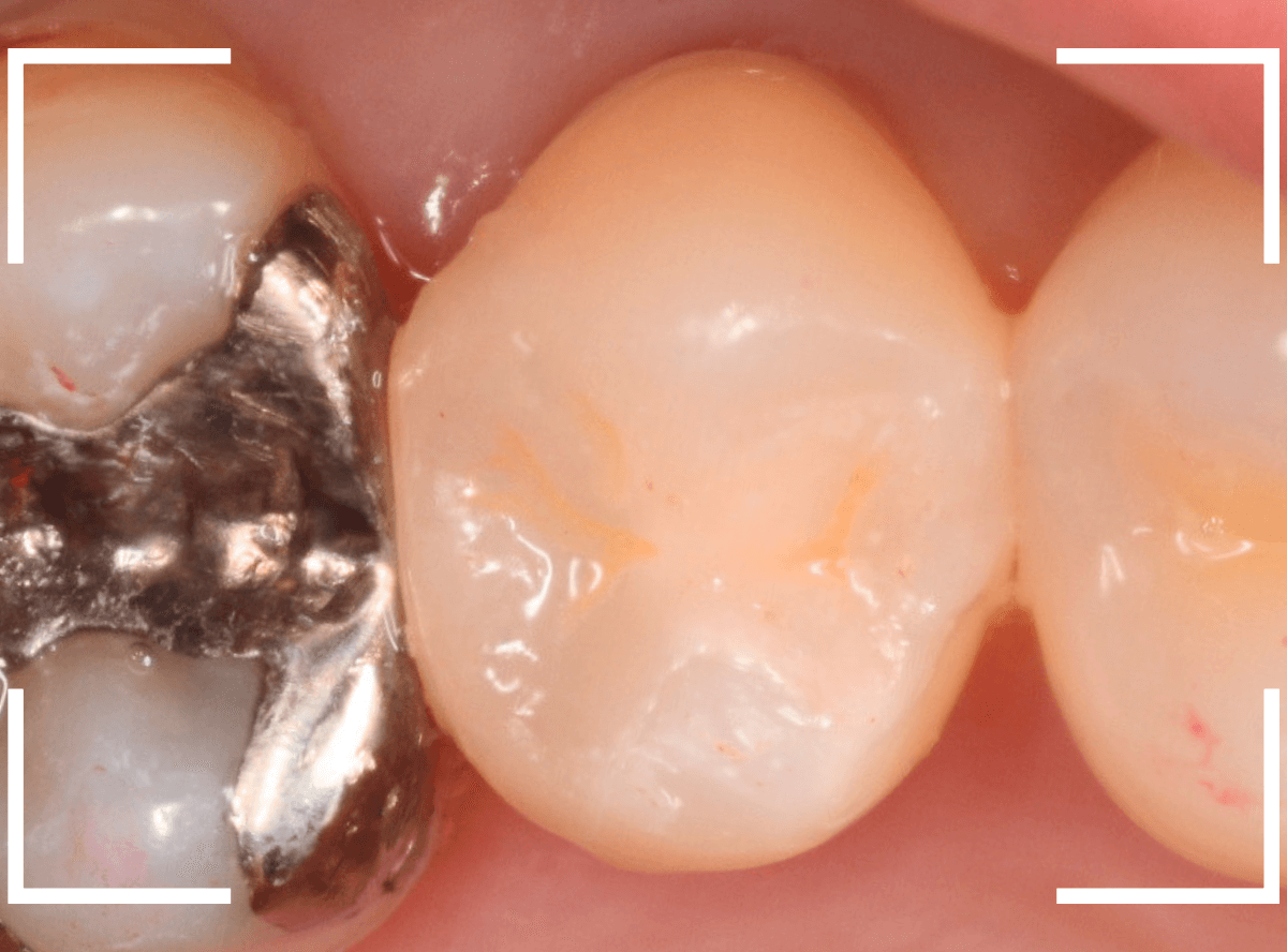 歯と歯の間の虫歯10-5
