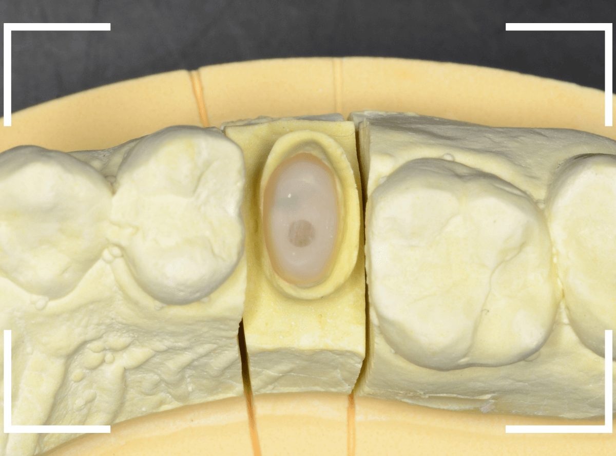 セラミック治療(クラウン・奥歯)9-6