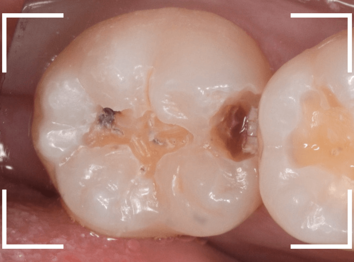 セラミック治療(インレー)16-1