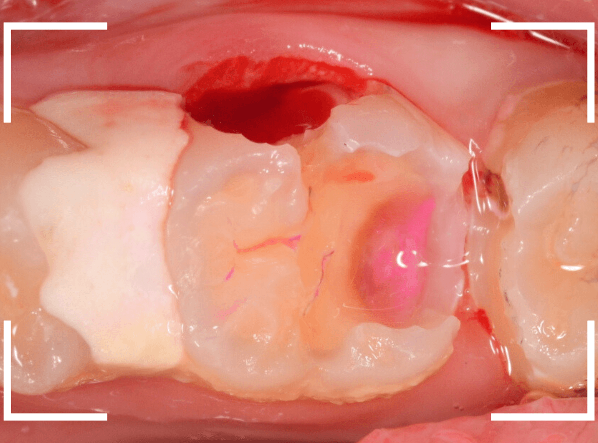 歯と歯の間の虫歯12-7