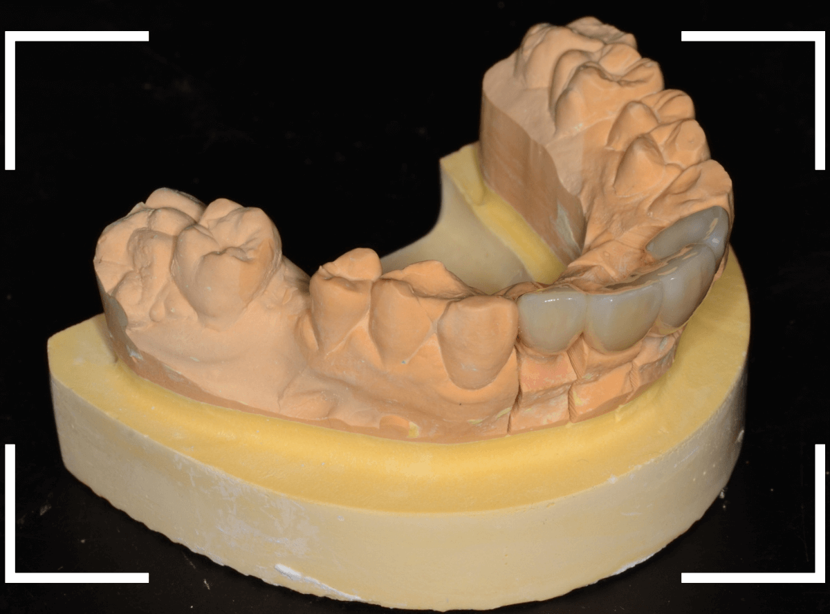 セラミック治療(前歯・クラウン)4-6