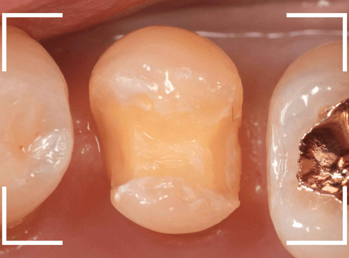 セラミック治療(インレー)25-2